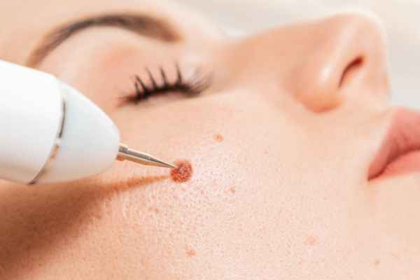 CryoPen: 5 Skin Concerns It May Be Used to Treat 3 What actually happens during a CryoPen treatment ?