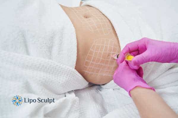 Aqualyx for Muffin Tops: What to Know Before Fat-Dissolving Injections 2 aqualyx fat injections