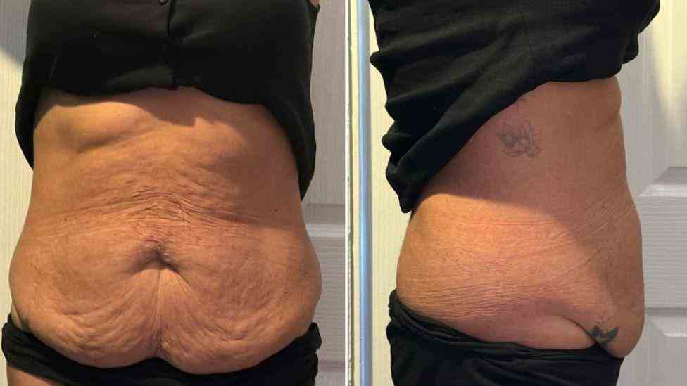Lost the Weight but Not the Loose Skin? What You Should Know 1 Is It Definitely Loose Skin ?