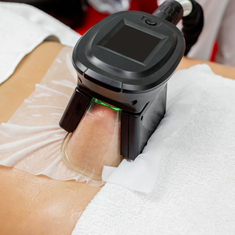 Fat Freezing treatment 