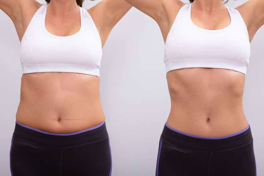 Aqualyx for Muffin Tops: What to Know Before Fat-Dissolving Injections 3 aqualyx injection before and after